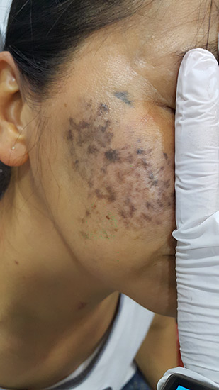 Fractional laser acne and scars result 2
