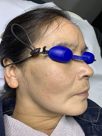 Fractional laser acne and scars result 4