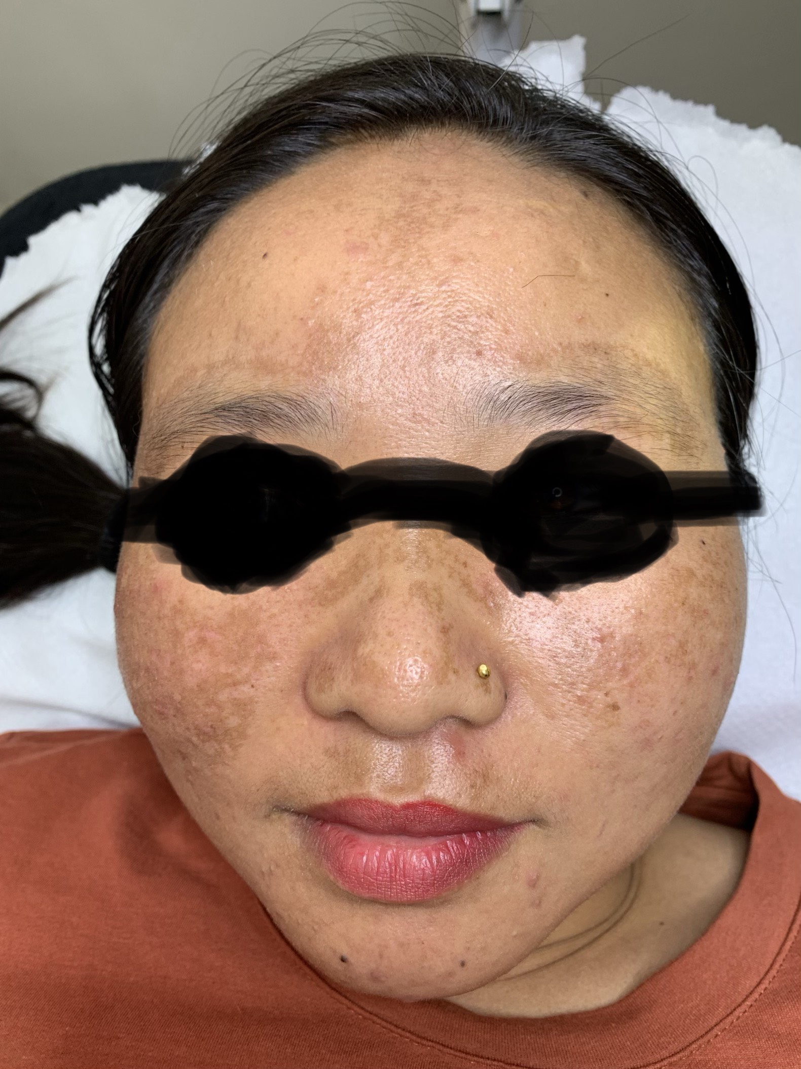 Fractional laser acne and scars result 8