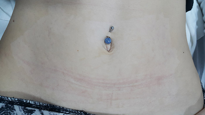 Fractional laser advanced stretch marks result 3