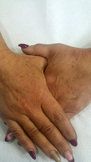 Fractional laser advanced stretch marks result 7