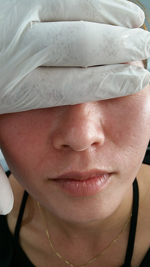 Fractional laser advanced stretch marks result 9