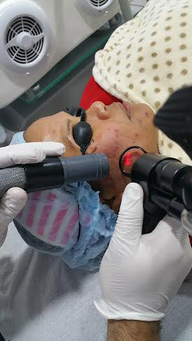 Fractional laser additional treatment result 2