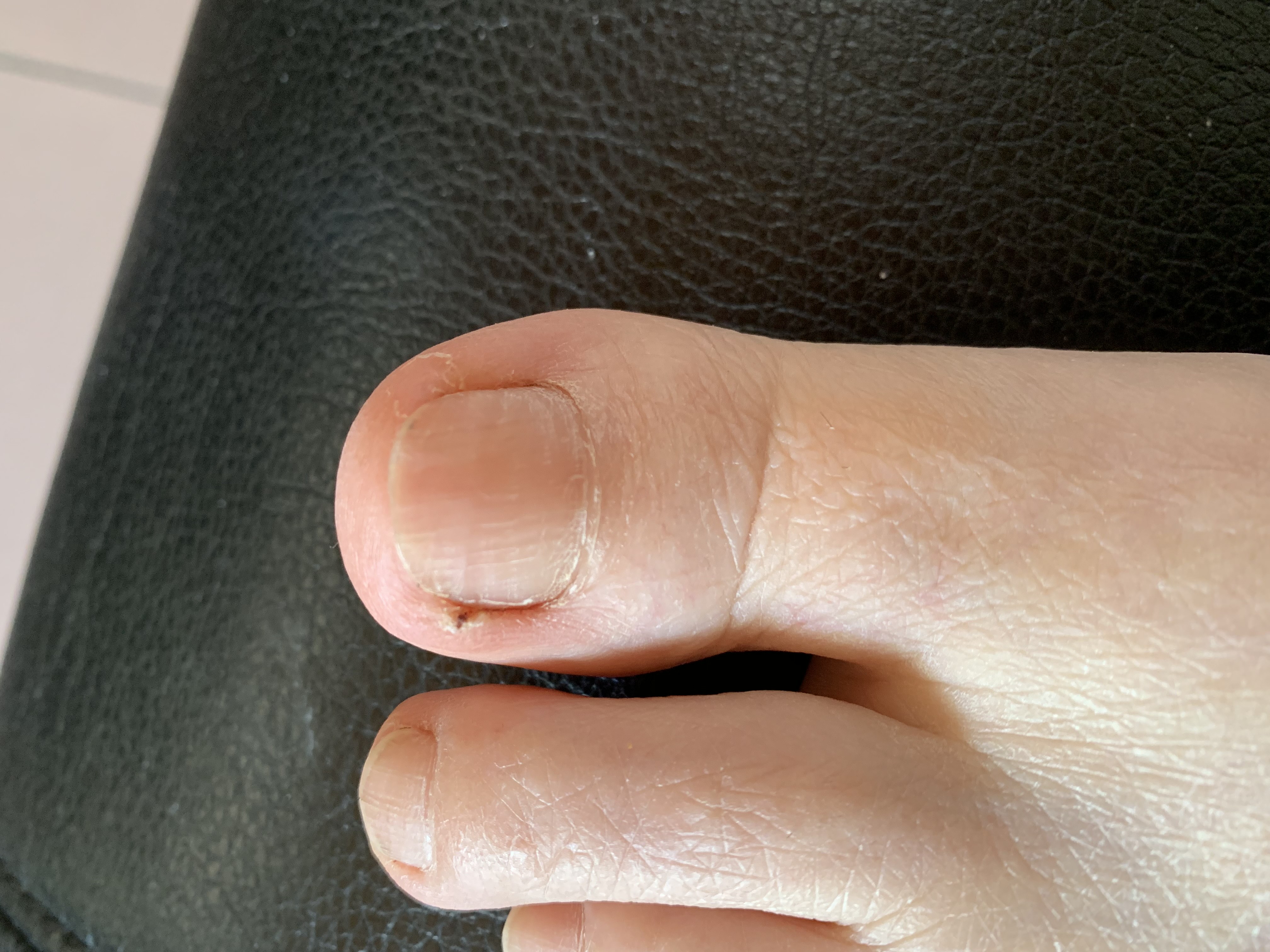 Laser nails fungus result 2