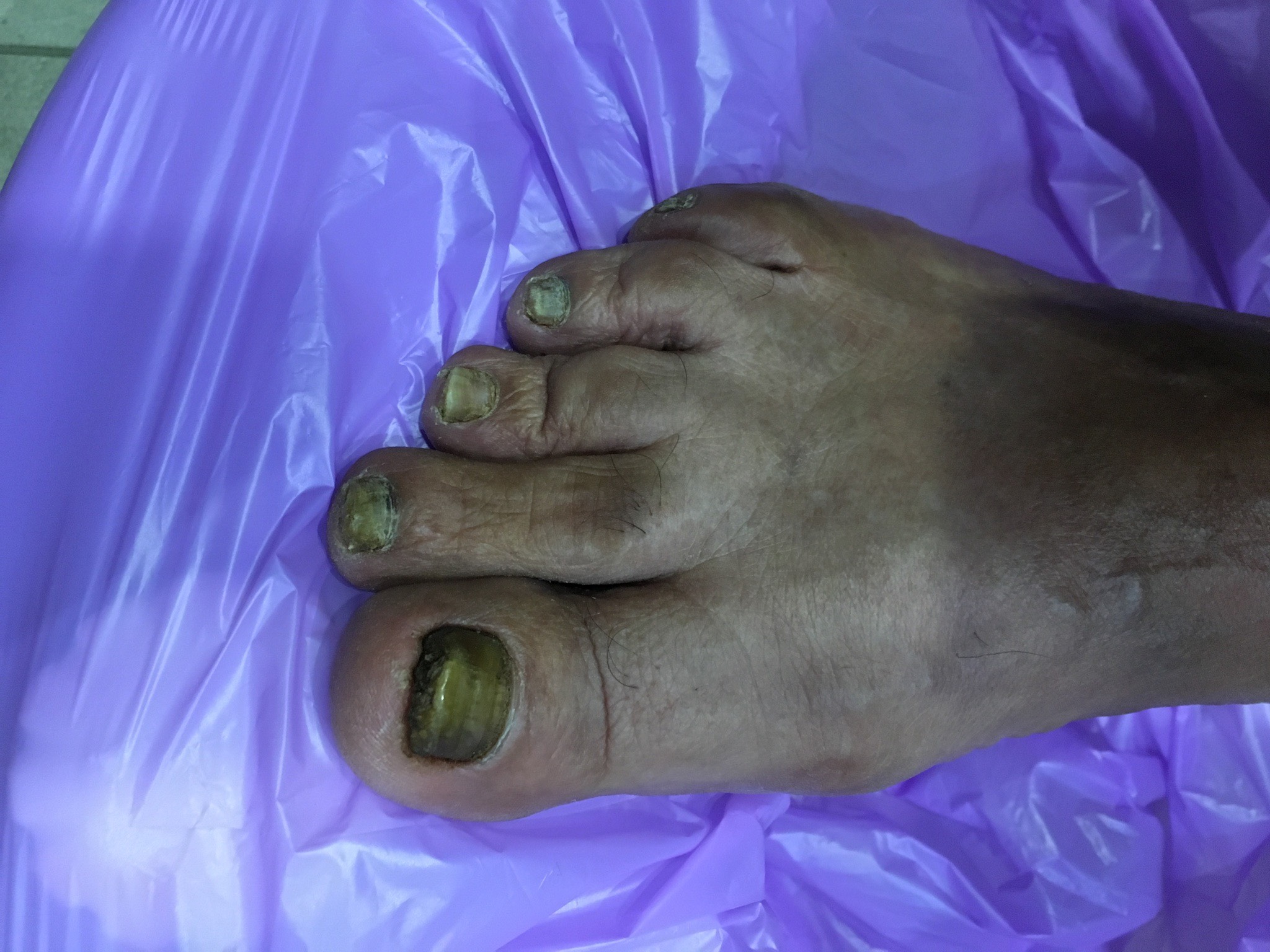 Laser nails fungus result 3