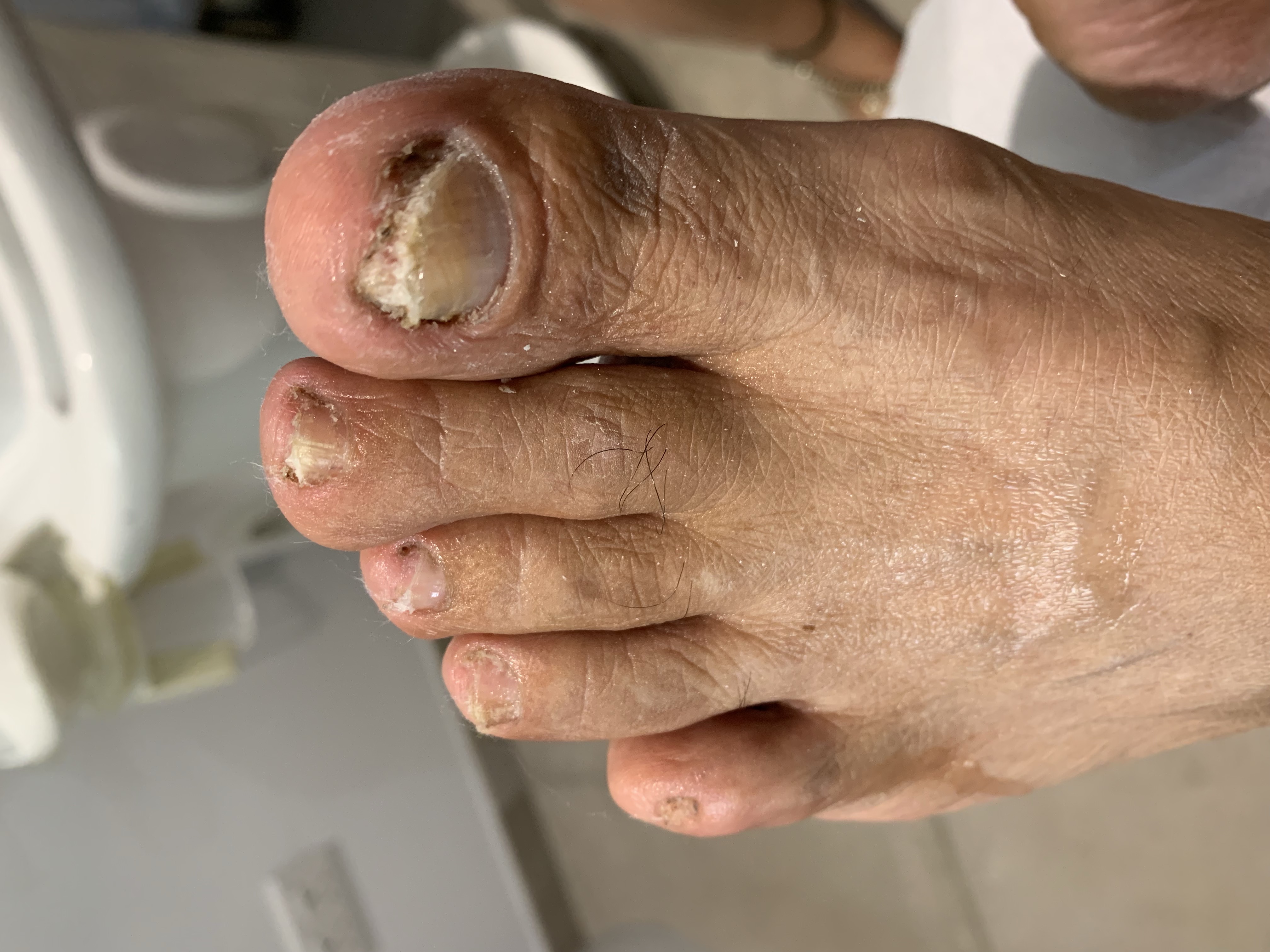 Laser nails fungus result 6