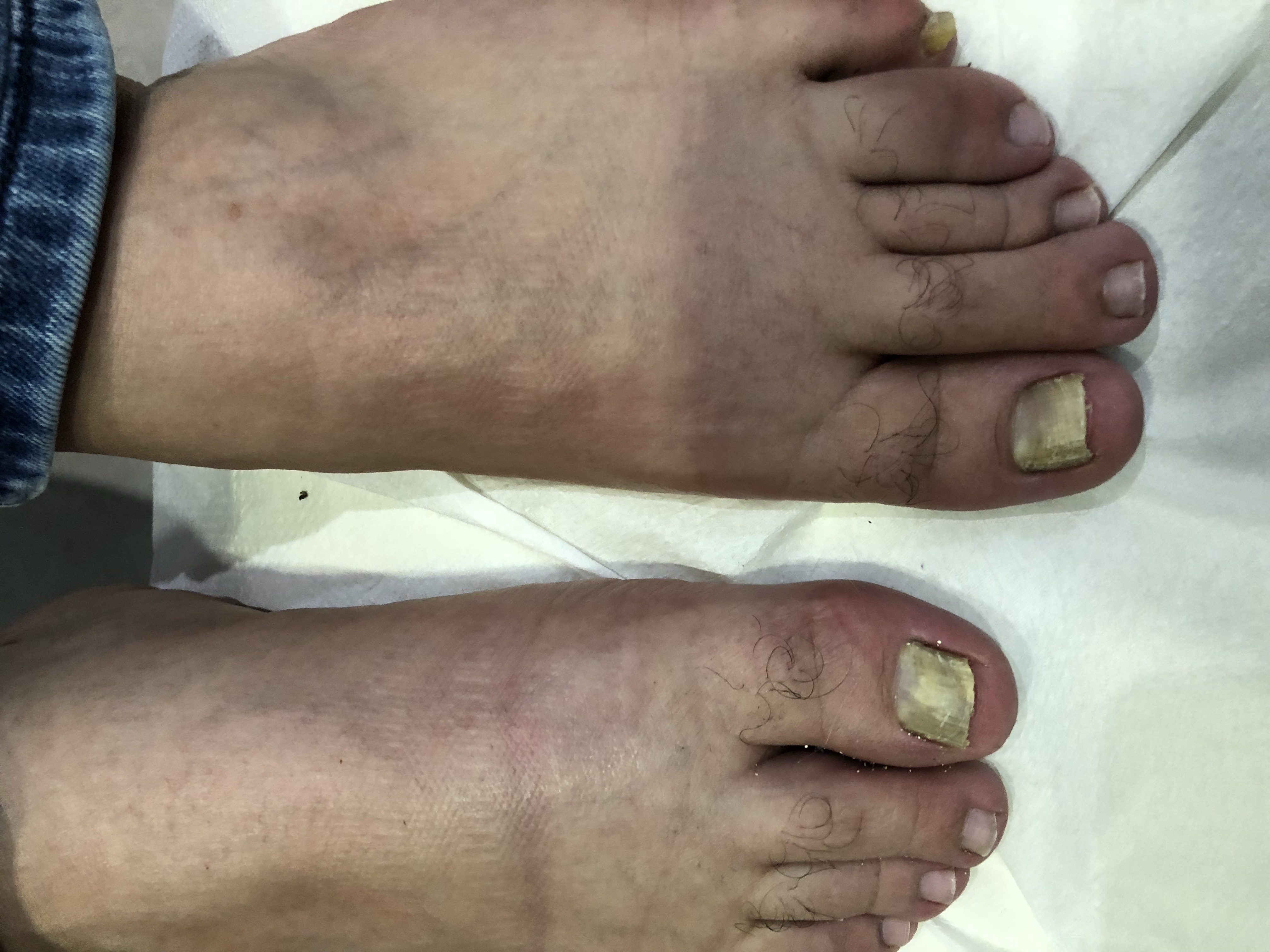 Laser nails fungus result 7