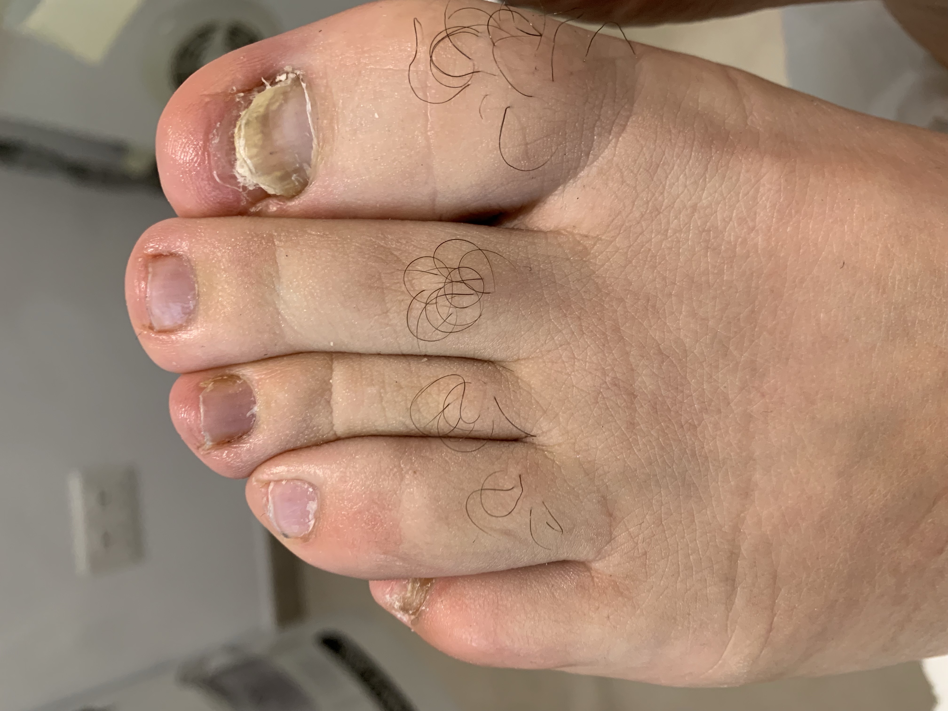 Laser nails fungus result 8