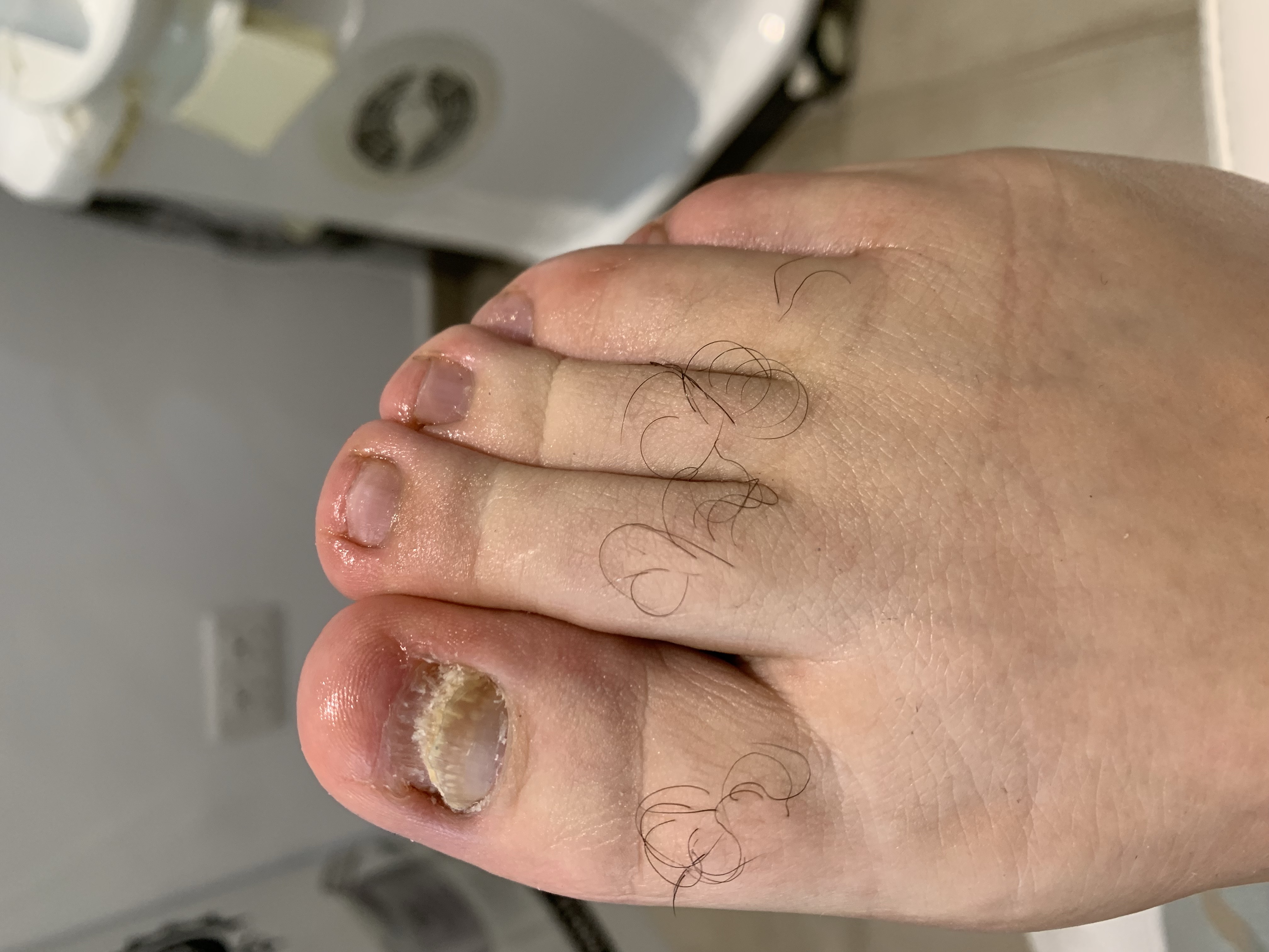 Laser nails fungus result 9