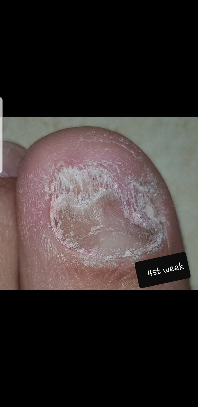 Laser nails fungus result 15