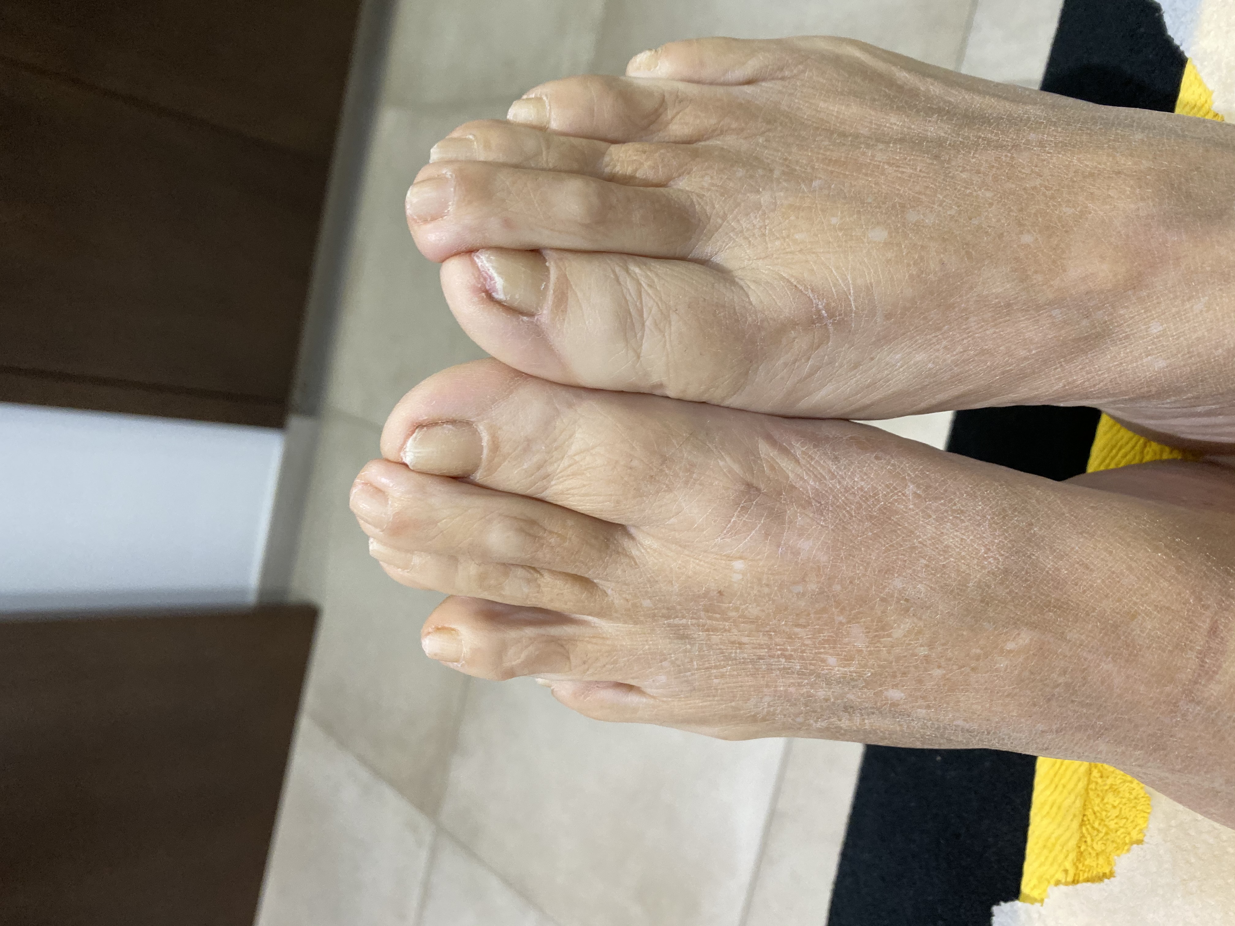 Laser nails fungus result 19