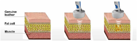 Liposonix gallery image 3