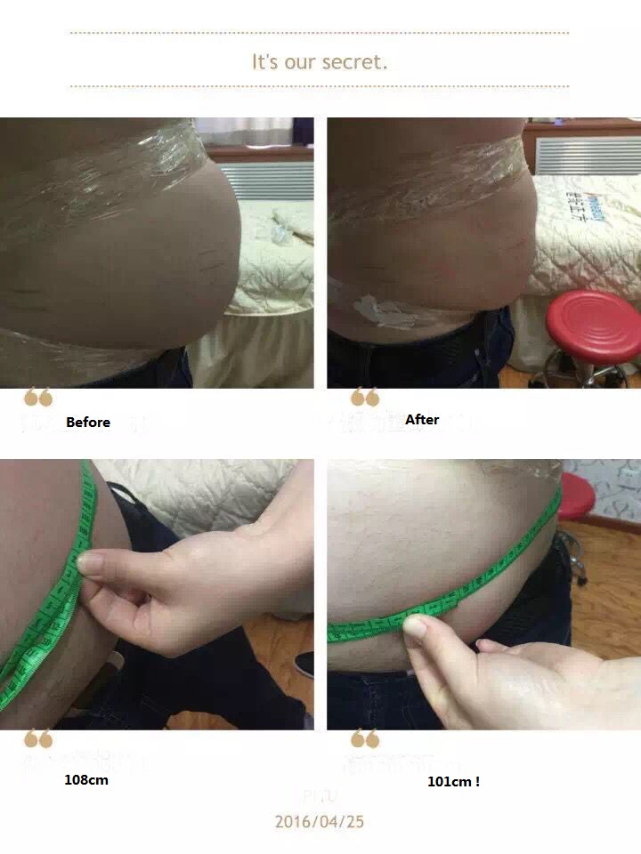 Liposonix treatment effect