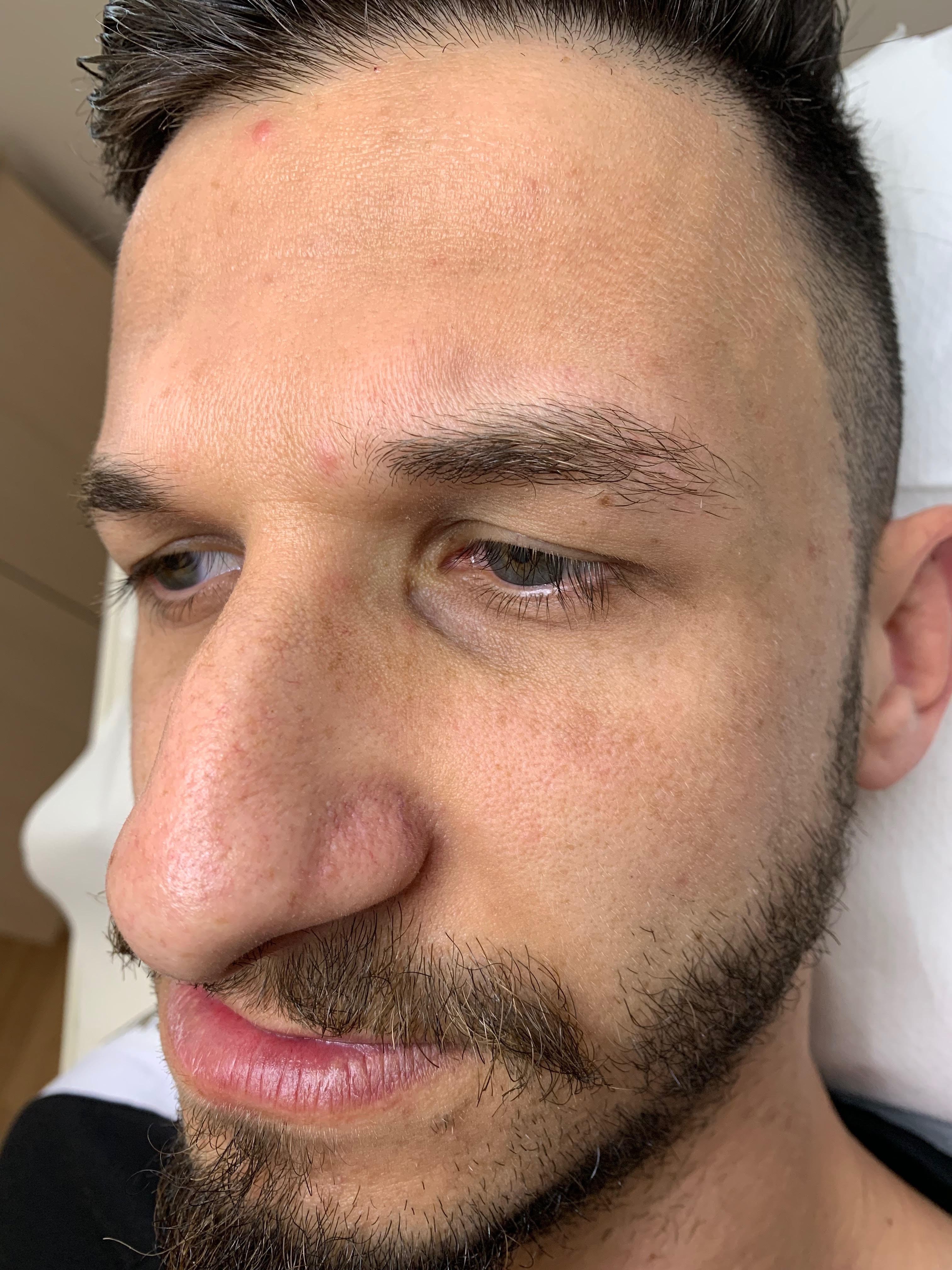 Carbon laser whitening result 3