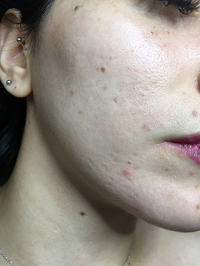 Carbon laser whitening result 7