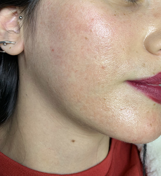 Carbon laser whitening result 9