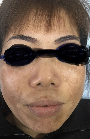 Carbon laser whitening result 10