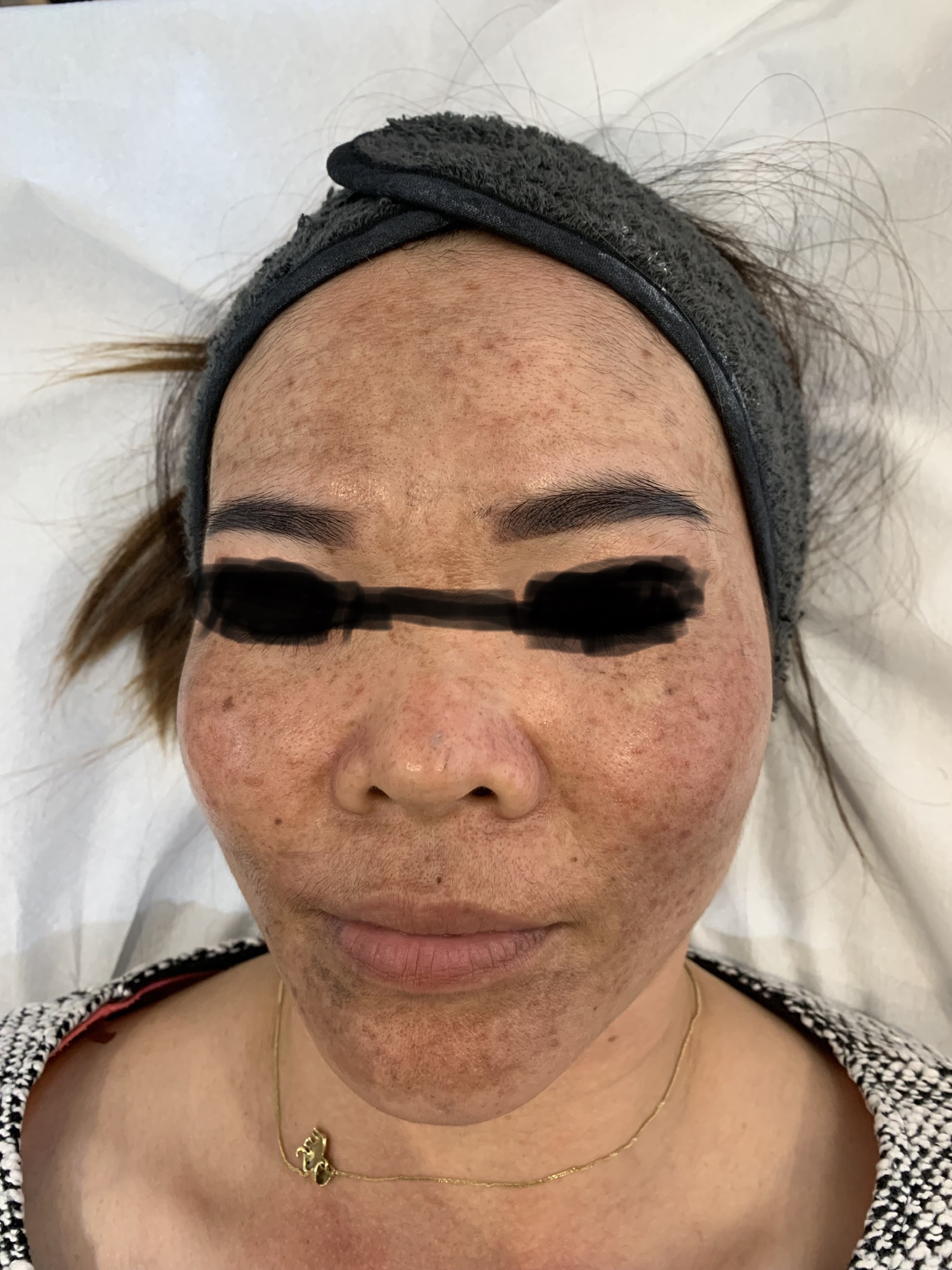 Carbon laser whitening result 12