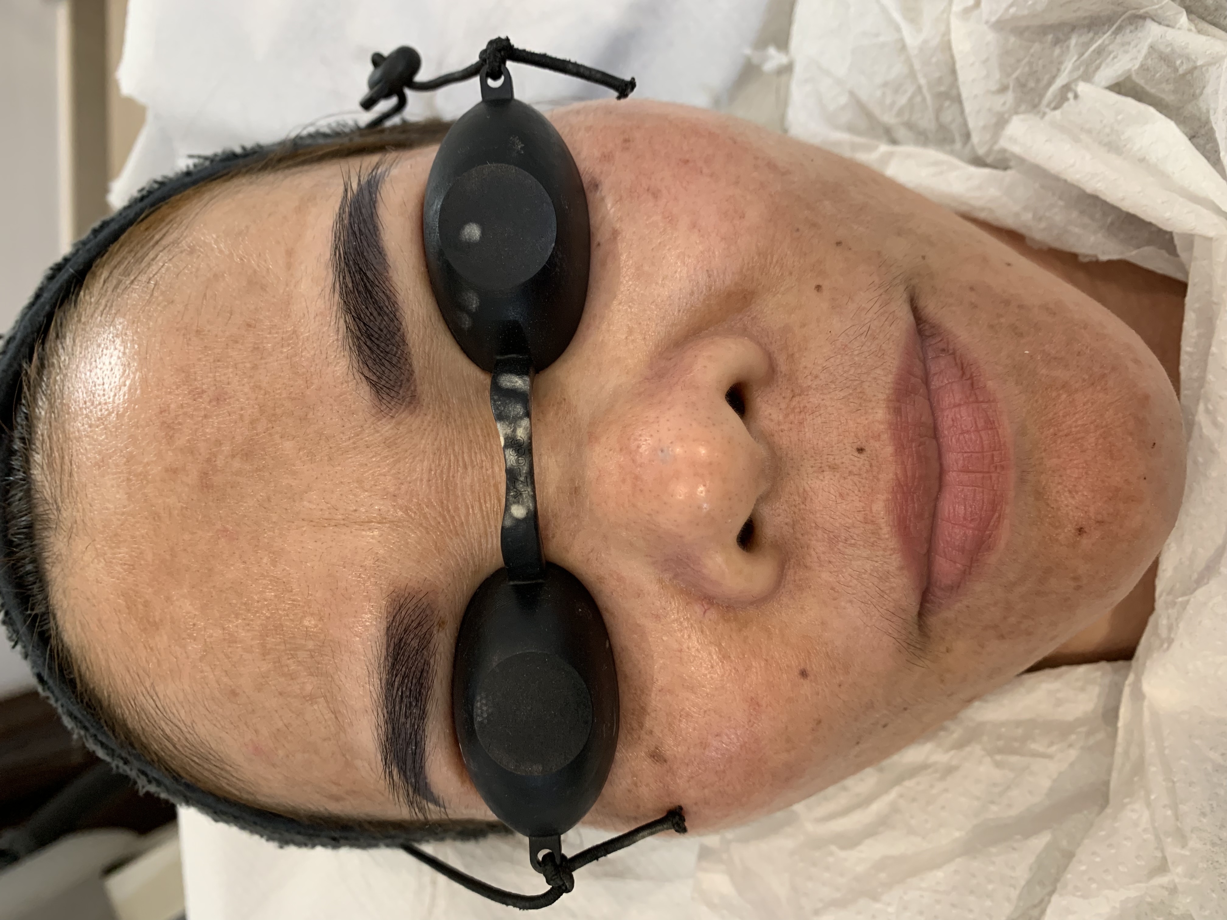 Carbon laser whitening result 13