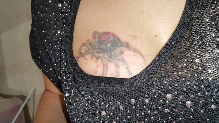 Laser tattoo removal before and after result 1