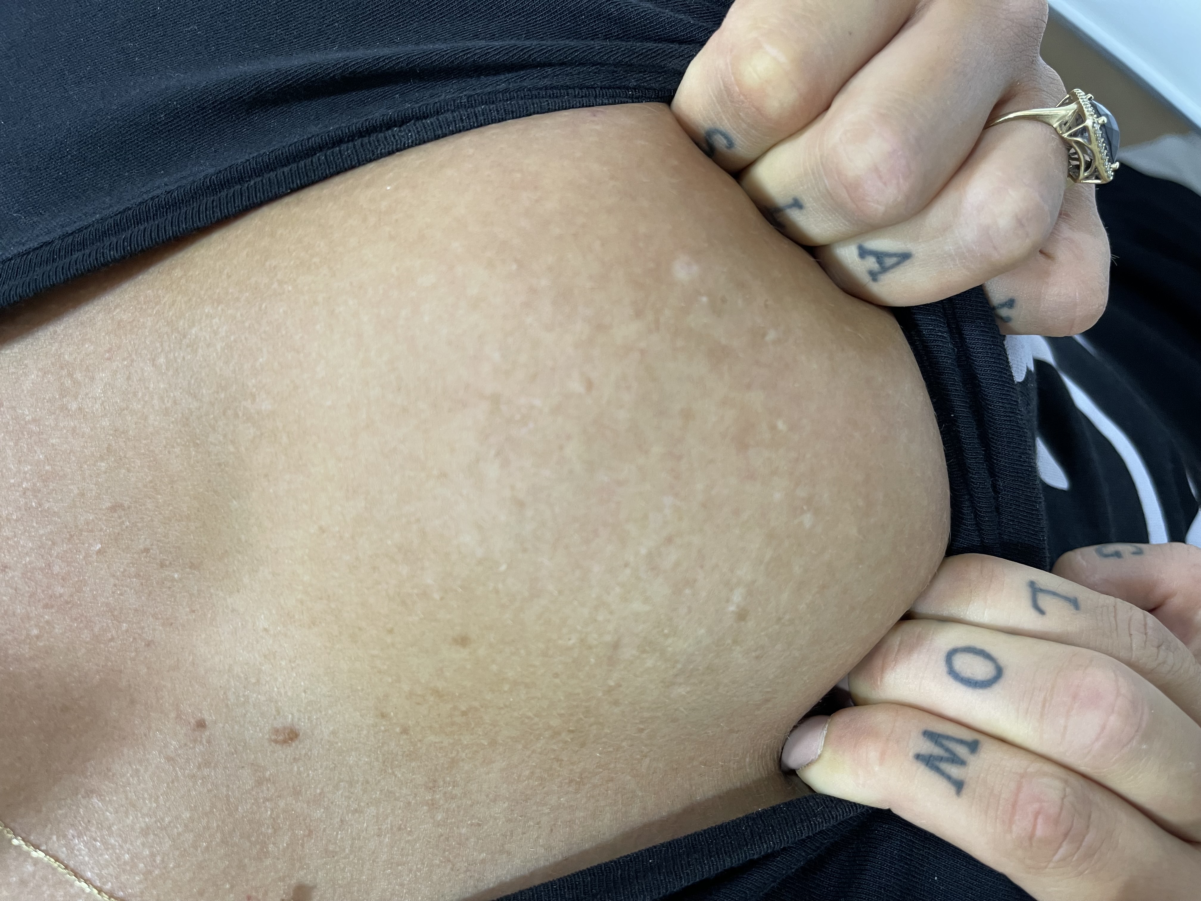 Laser tattoo removal before and after result 2