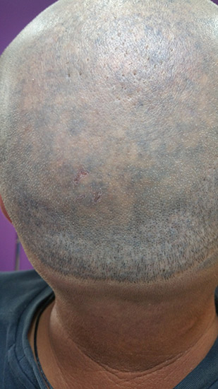 Laser tattoo removal before and after result 3