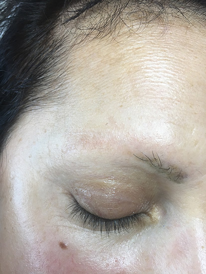 Laser tattoo removal before and after result 8