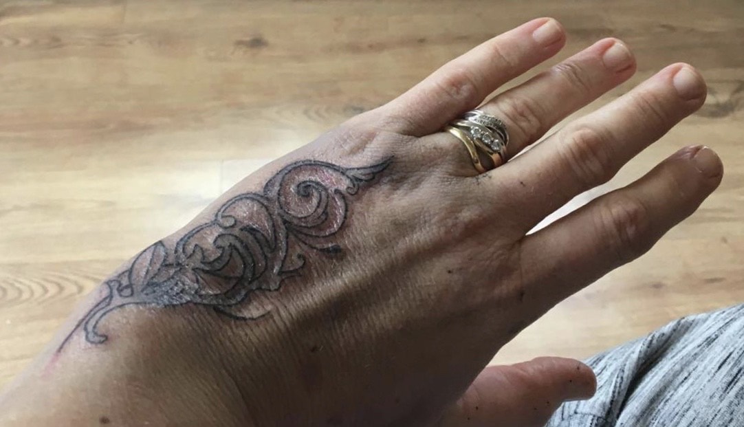 Laser tattoo removal before and after result 11